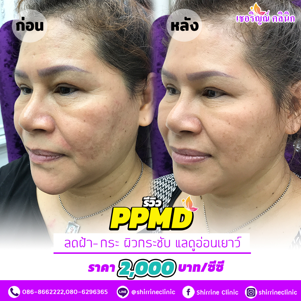 รีวิว PPMD ลดฝ้า-กระ