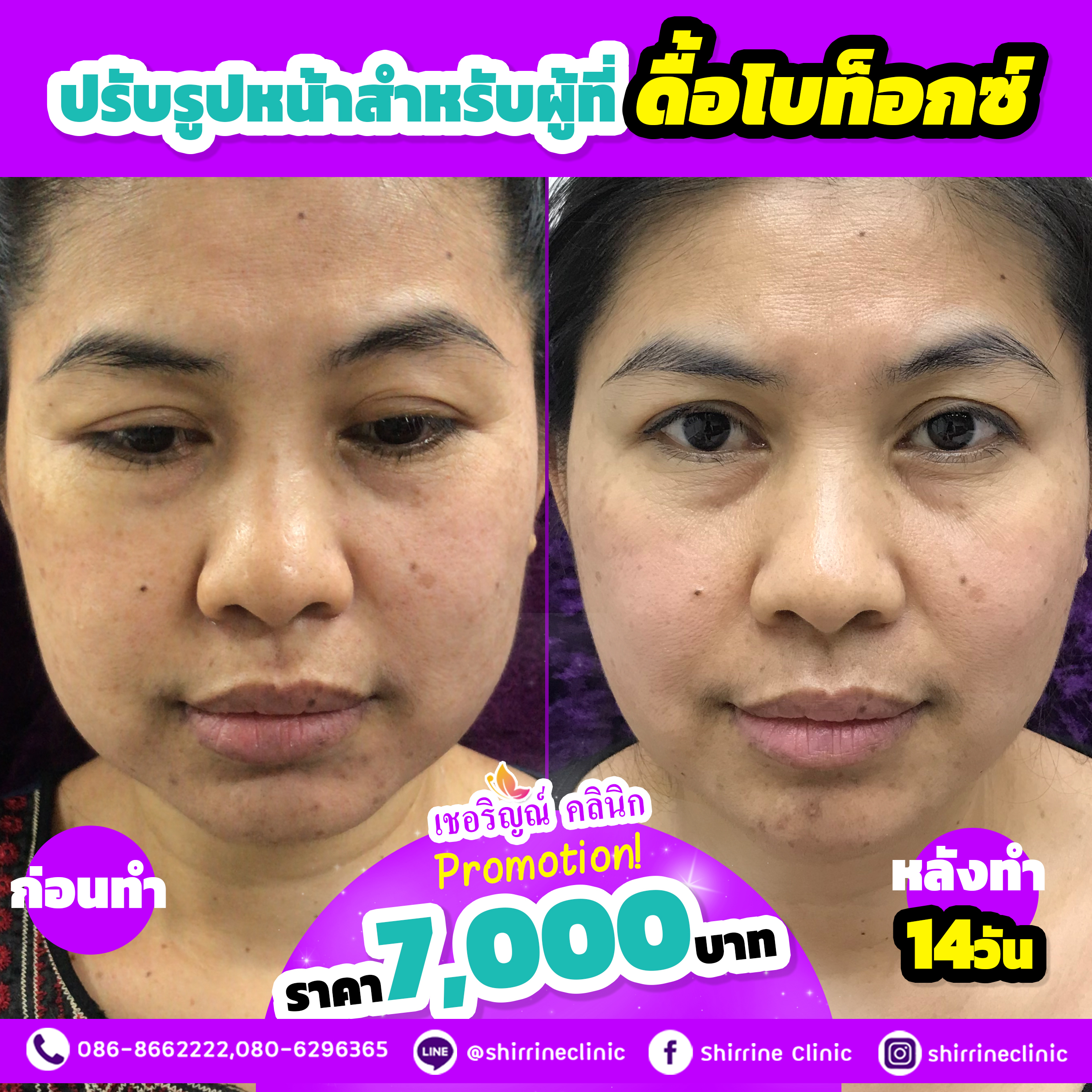 ปรับรูปหน้าสำหรับผู้ที่ดื้อโบท็อกซ์