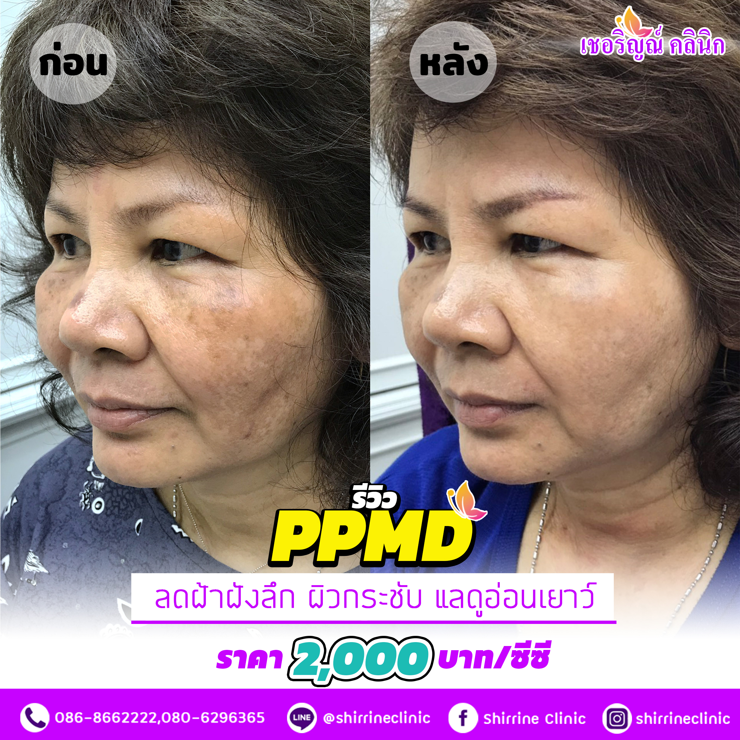 รีวิว PPMD ลดฝ้า-กระ