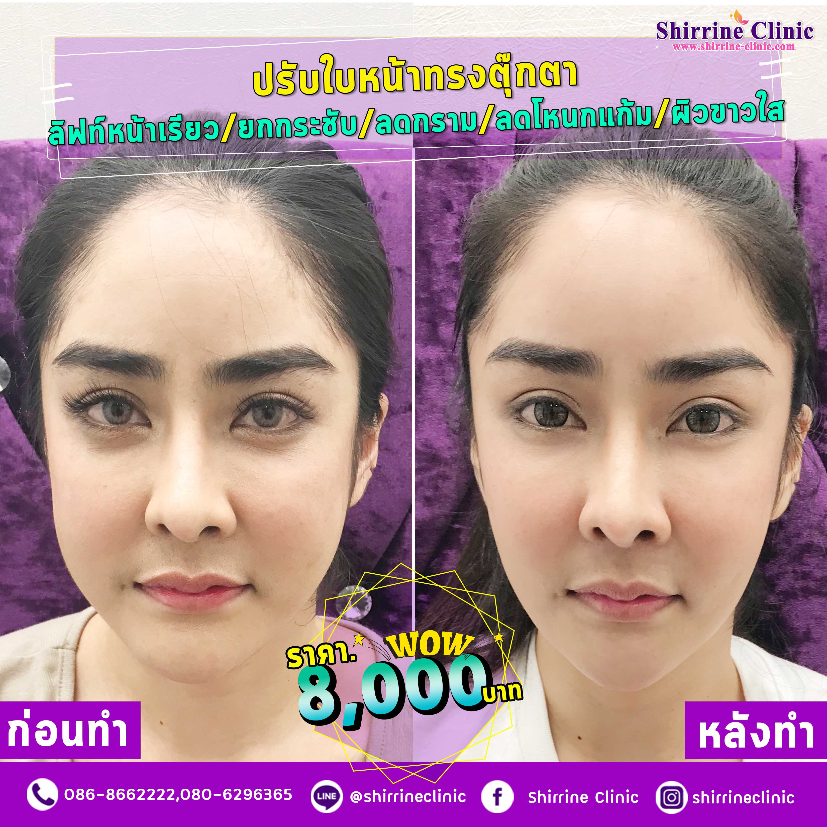 ปรับรูปหน้าทรงตุ๊กตา หน้าไม่ตอบ หน้าเรียวแบบมีแก้ม