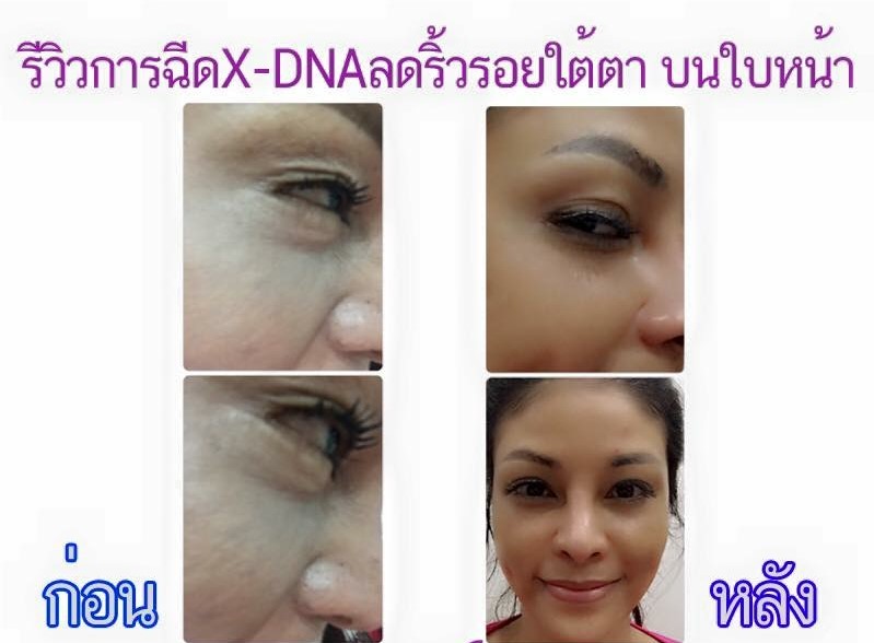 ลดกระฝ้า รอยดำ หน้าใส ยกกระชับใบหน้า