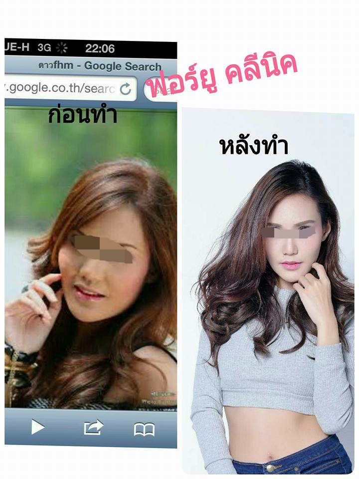 โบท็อกซ์ปรับรูปหน้า ลดริ้วรอย