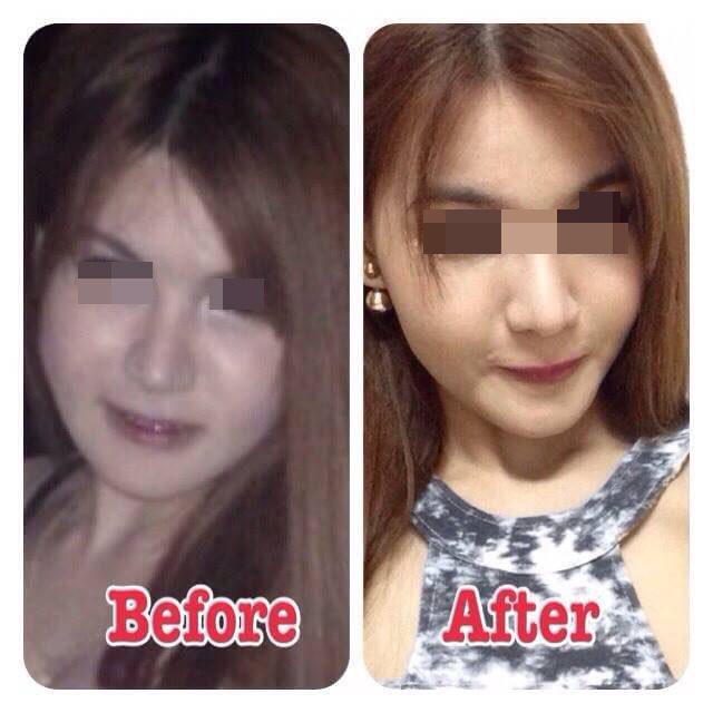 โบท็อกซ์ปรับรูปหน้า ลดริ้วรอย