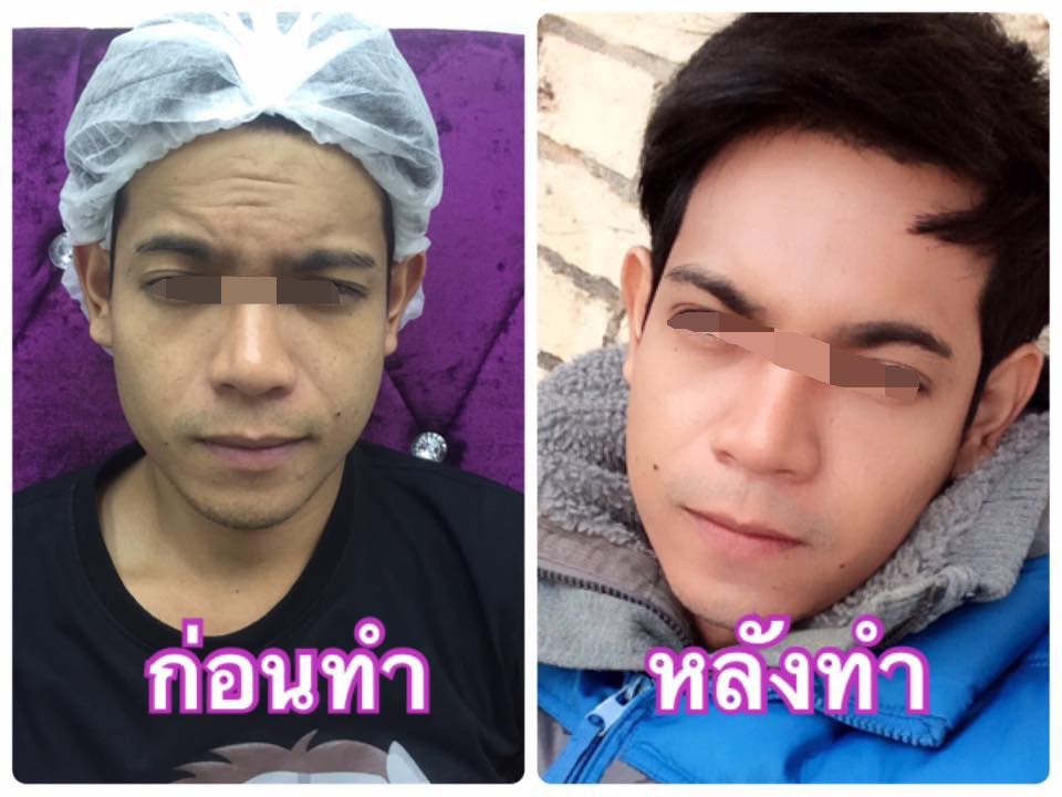โบท็อกซ์ปรับรูปหน้า ลดริ้วรอย