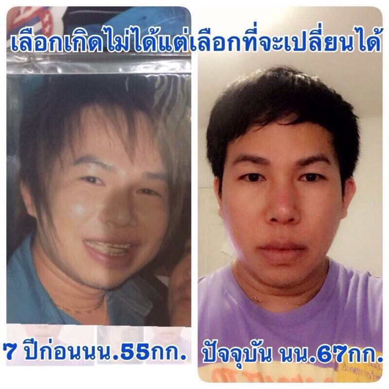 โบท็อกซ์ปรับรูปหน้า ลดริ้วรอย