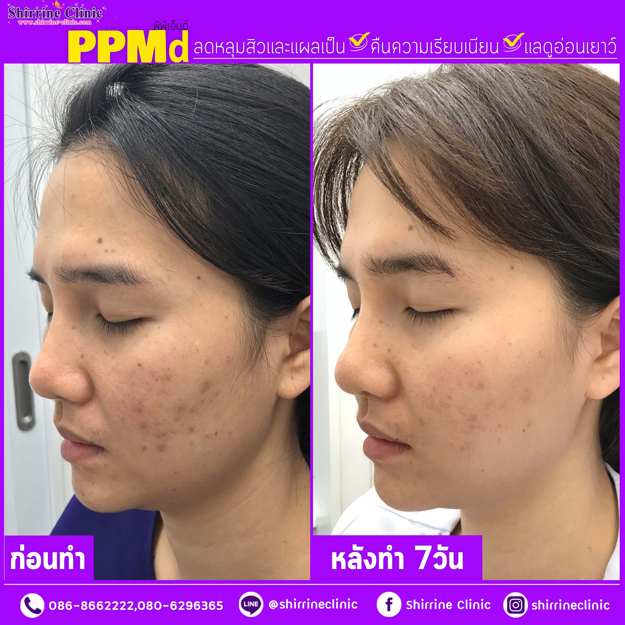 ลดกระฝ้า รอยดำ หน้าใส ยกกระชับใบหน้า