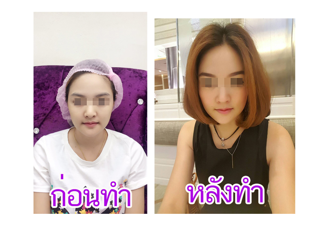โบท็อกซ์ปรับรูปหน้า ลดริ้วรอย